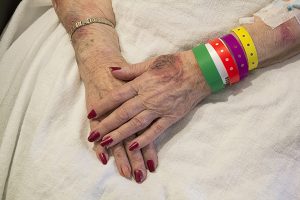 Bruised Hands of Elderly Woman